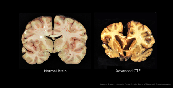 Chronic Traumatic Encephalopathy or CTE