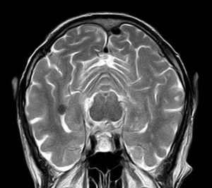 PTSD Brain Details